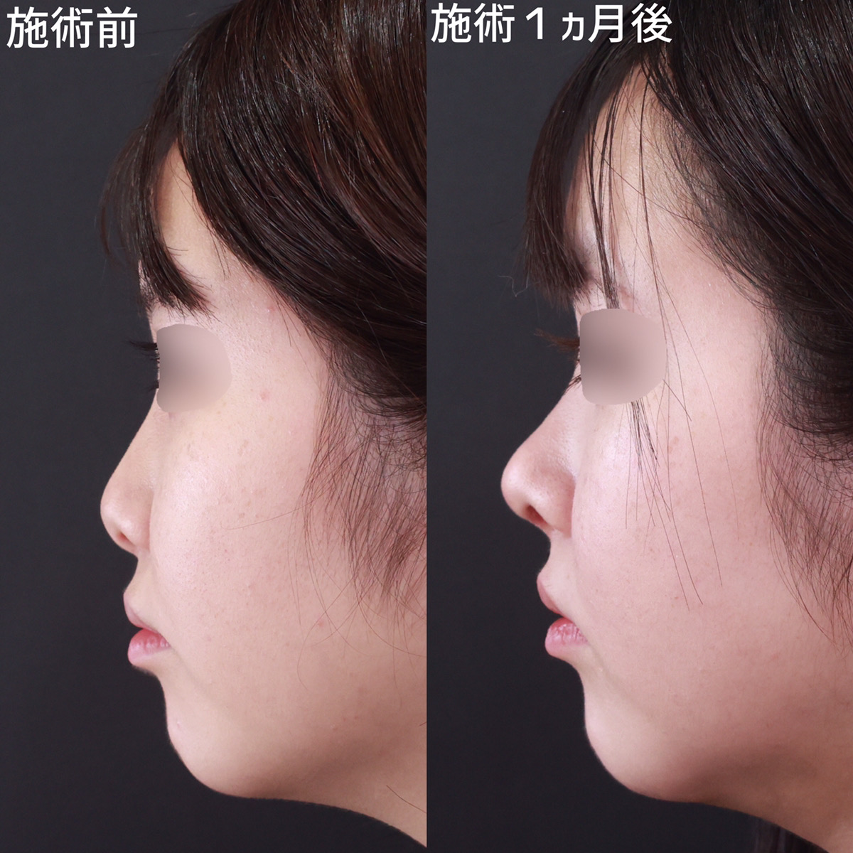 鼻中隔延長術と鼻尖形成、軟骨移植でアップノーズの華やか鼻｜症例写真・ビフォーアフター｜美容整形･美容外科のTAクリニックグループ