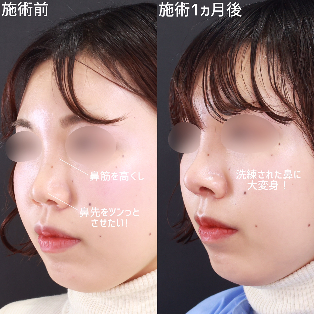 鼻尖形成・鼻尖縮小/鼻先軟骨移植/鼻中隔延長術の症例写真 施術前後 