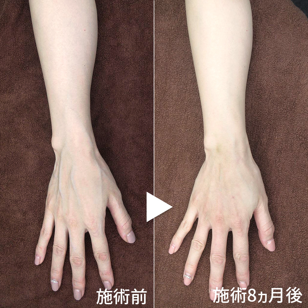 ハンドベイン（手のアンチエイジング・血管治療）の症例写真 施術前後 