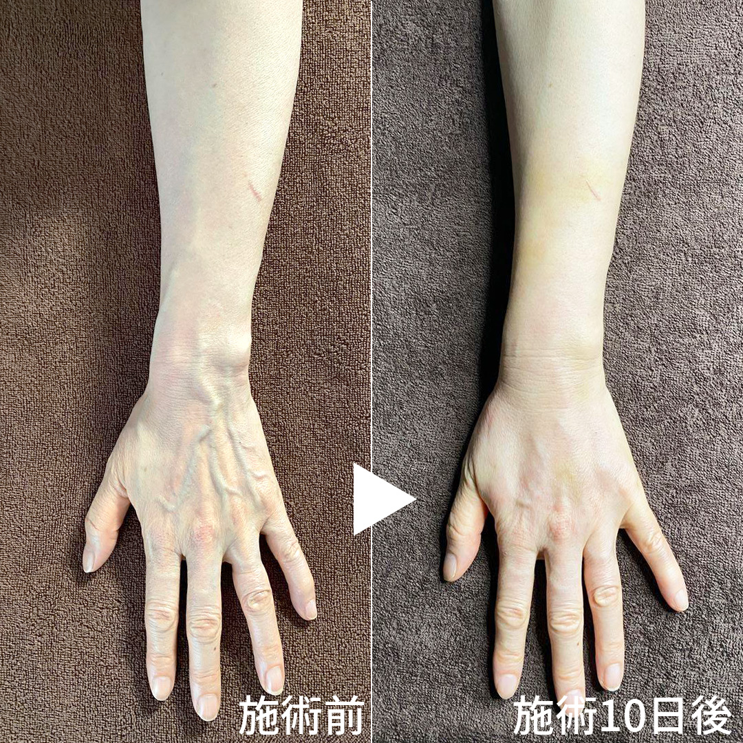 ハンドベイン（手のアンチエイジング・血管治療）の症例写真 施術前後 