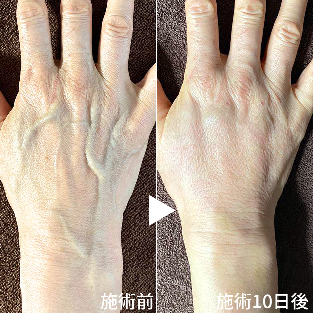 ハンドベイン（手のアンチエイジング・血管治療）の症例写真 施術前後 