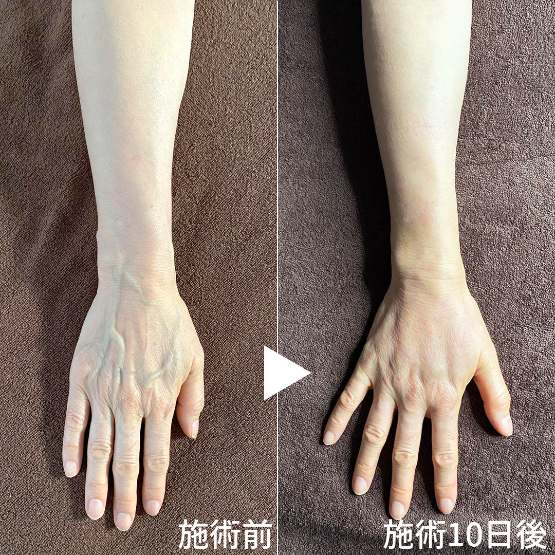 ハンドベイン（手のアンチエイジング・血管治療）の症例写真 施術前後 