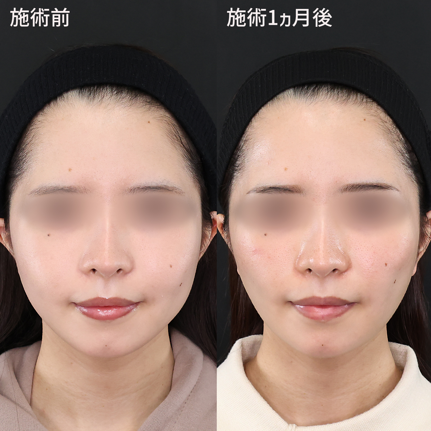 お顔の脂肪除去でつくる理想のフェイスライン