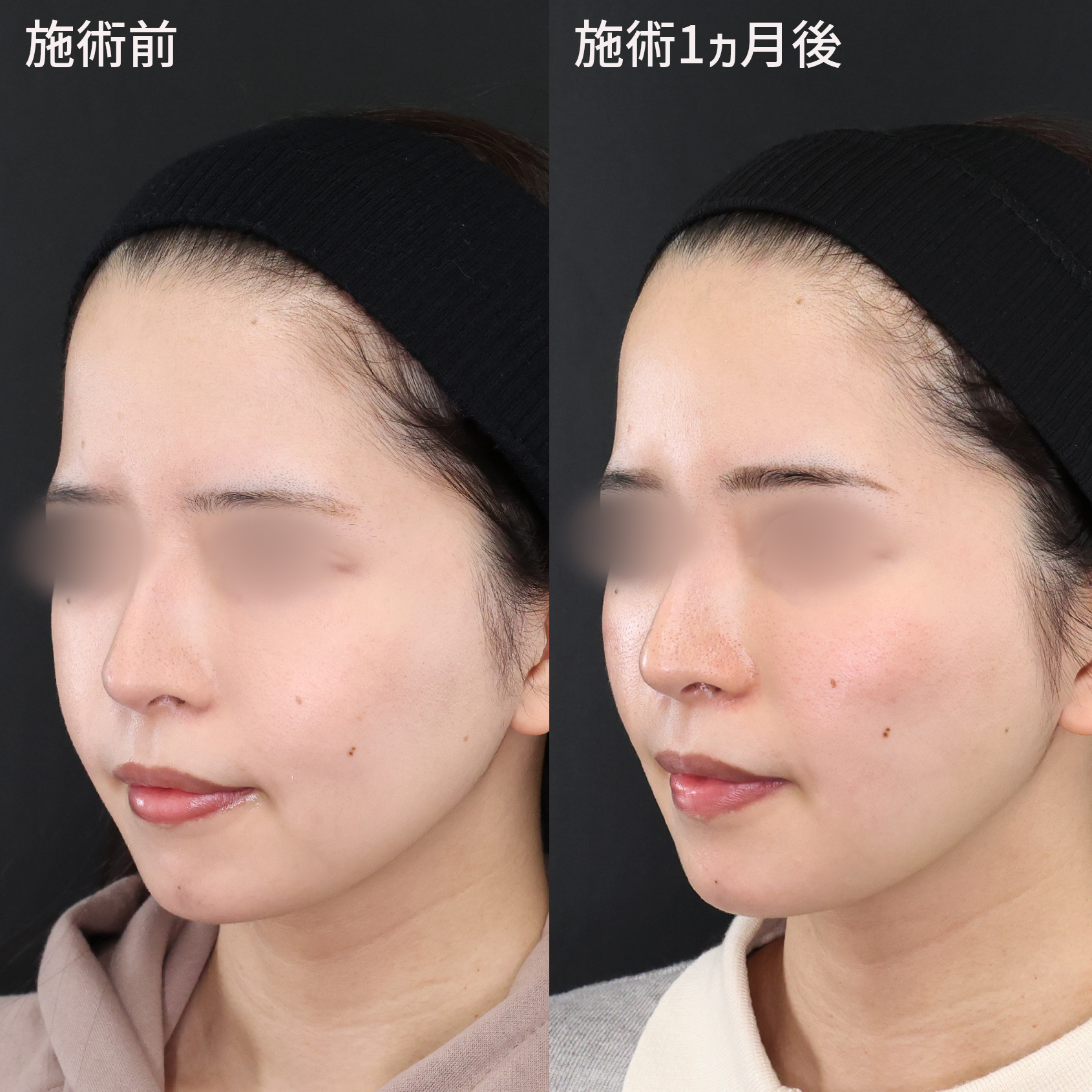 ジョールファット除去/バッカルファット除去/メーラーファット除去の症例写真 施術前後 