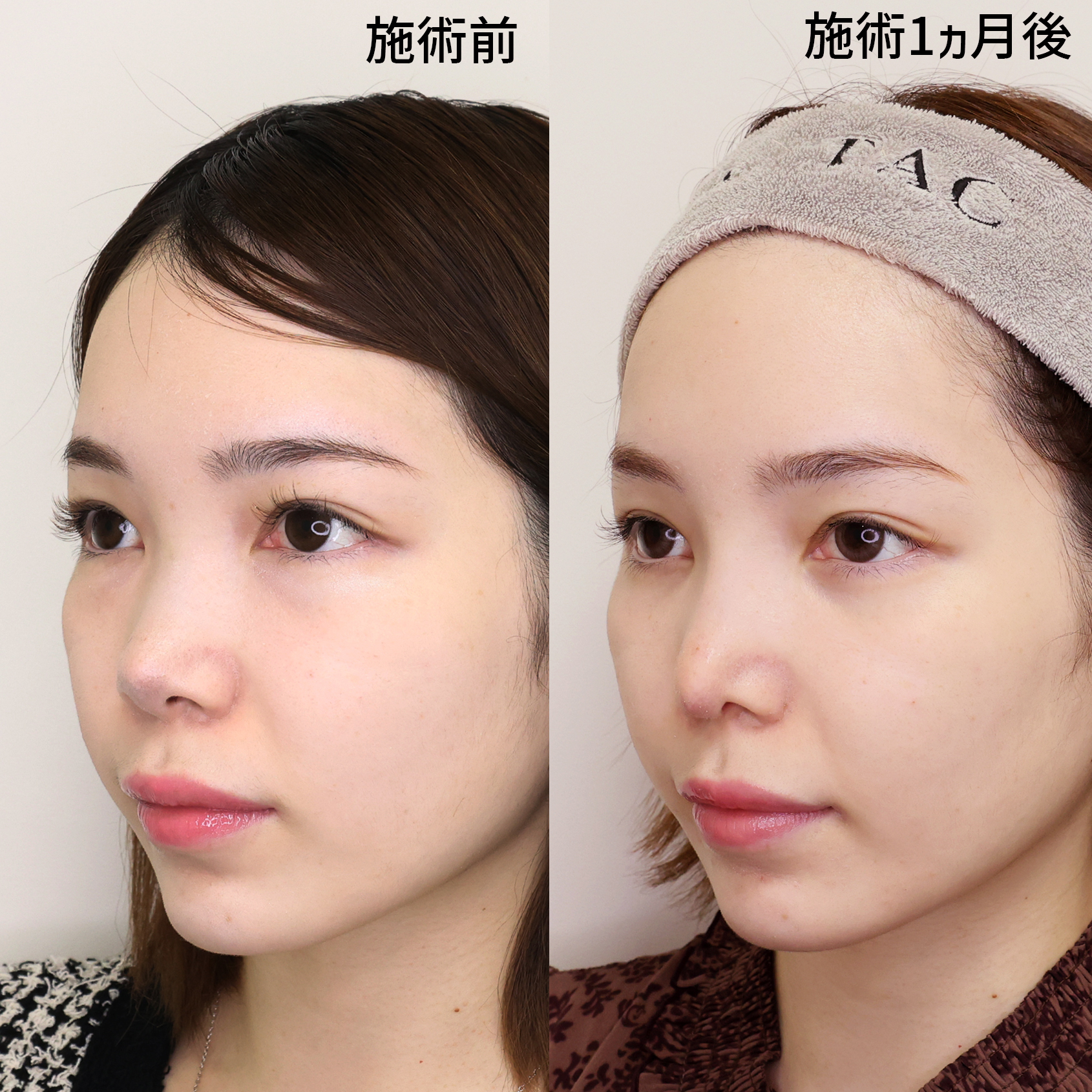 上向きだった鼻先を修正して美しい鼻唇角をつくる。ワンランク上の洗練された横顔美人へ。