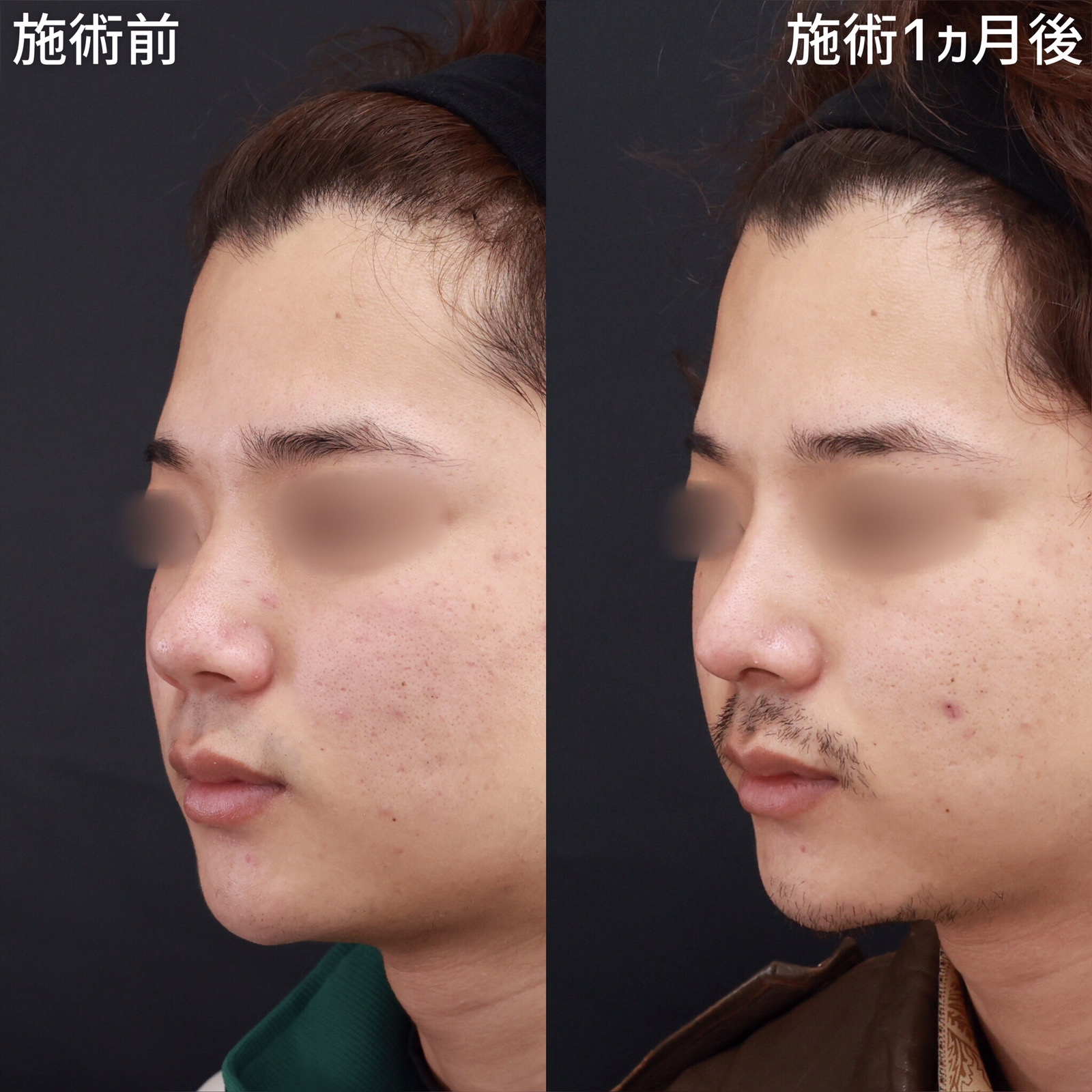 鼻尖形成・鼻尖縮小/鼻先軟骨移植/隆鼻術（プロテーゼ・自家組織）の症例写真 施術前後 