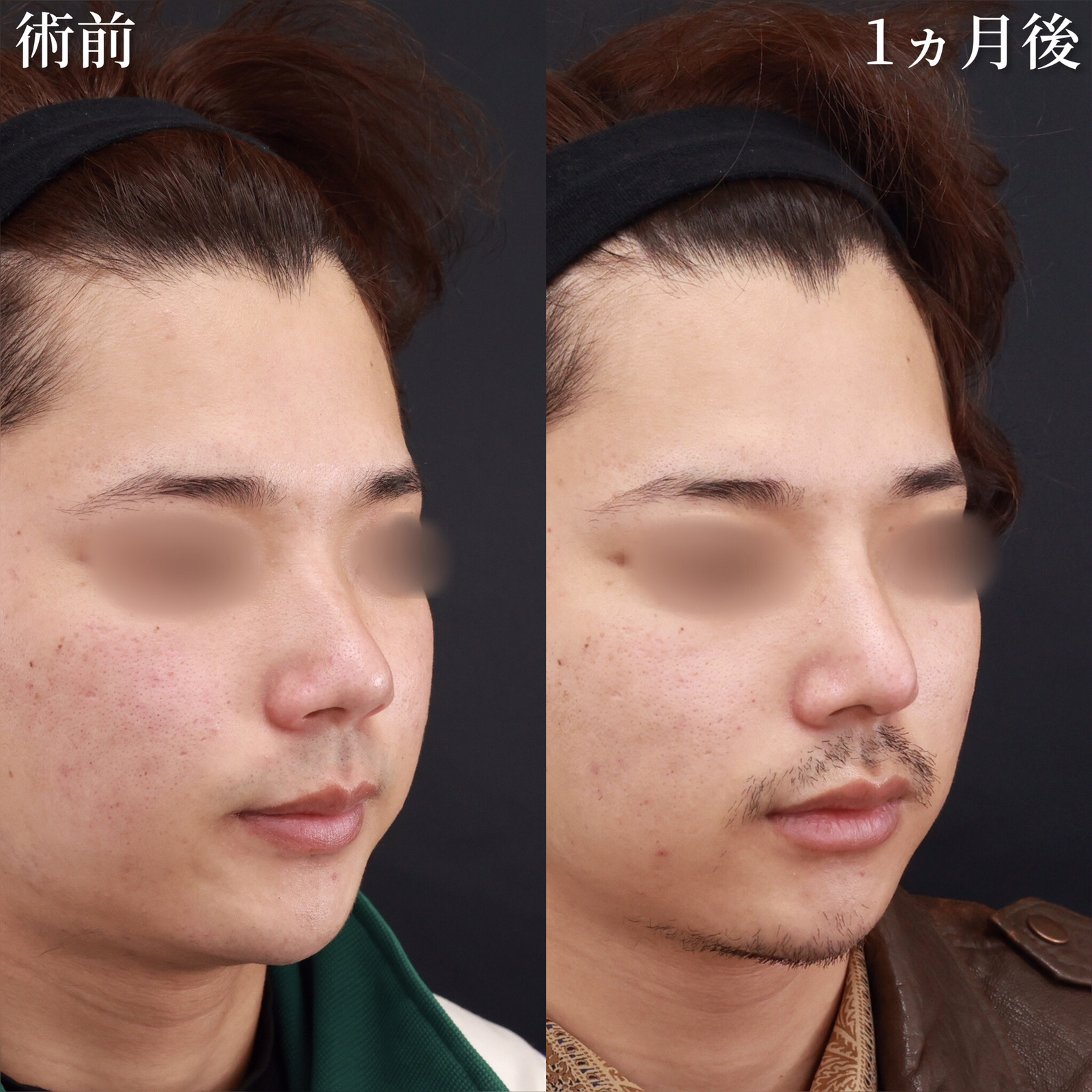 鼻尖形成・鼻尖縮小/鼻先軟骨移植/隆鼻術（プロテーゼ・自家組織）の症例写真 施術前後 