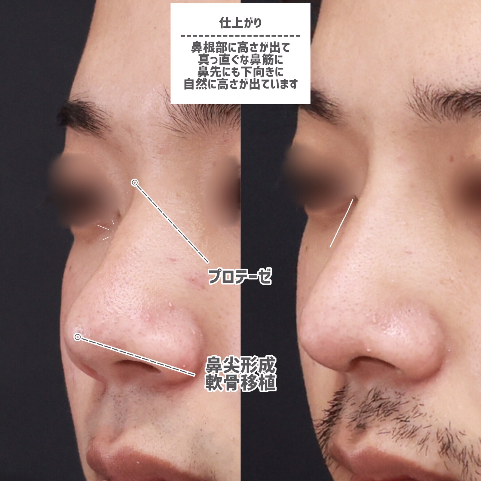 鼻尖形成・鼻尖縮小/鼻先軟骨移植/隆鼻術（プロテーゼ・自家組織）の症例写真 施術前後 