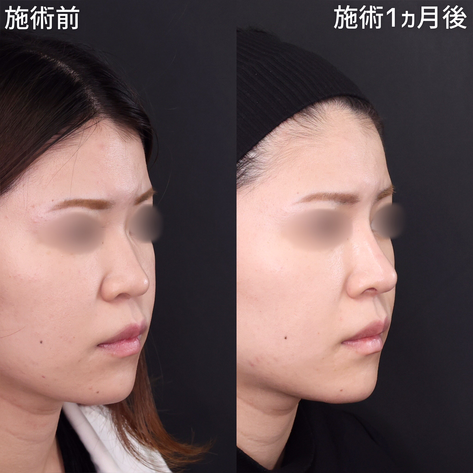 鼻中隔延長術/鼻尖形成・鼻尖縮小/鼻先軟骨移植の症例写真 施術前後 