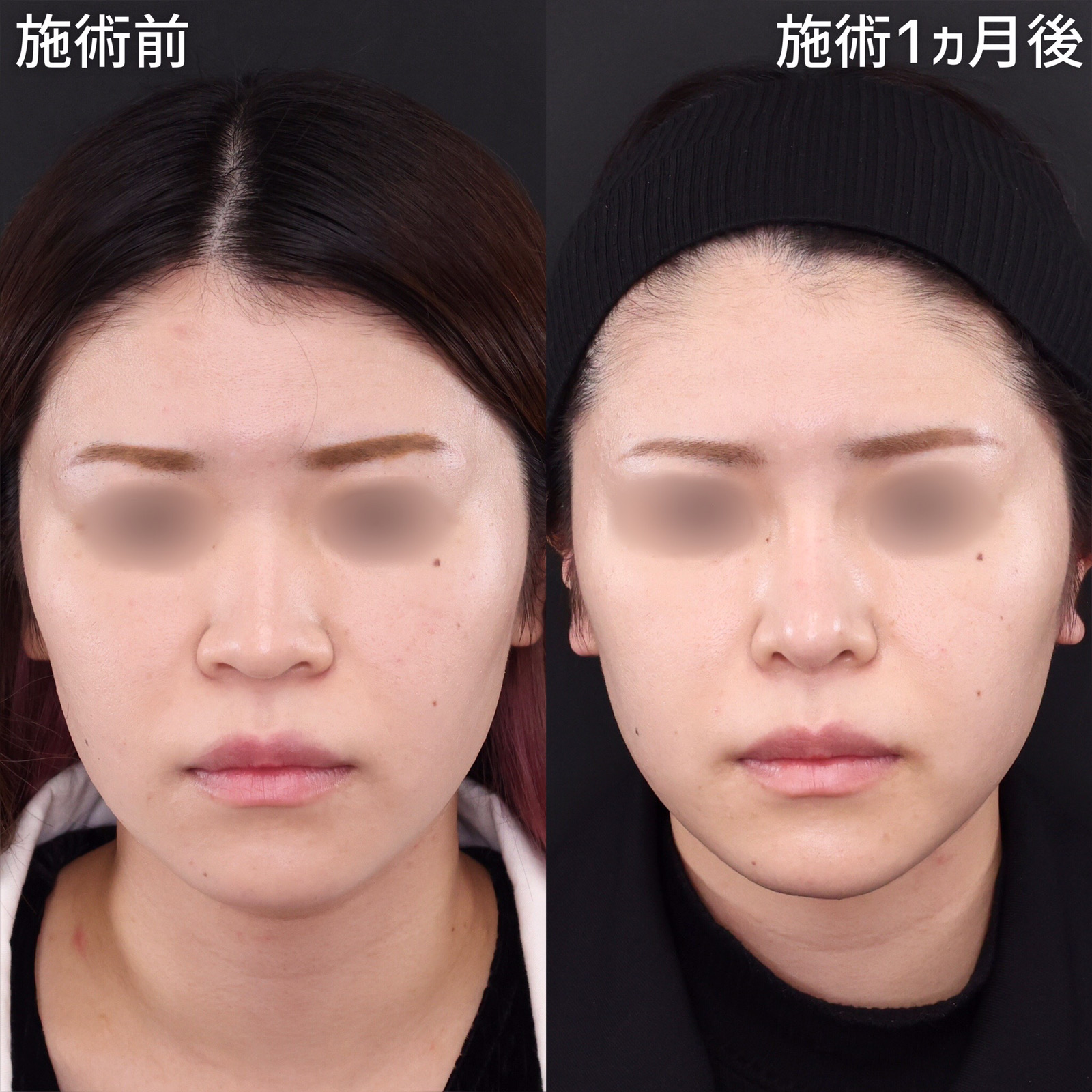 【裁断済み】鼻形成術 = 美容外科手術手技 鼻形成術 | 克誠堂出版