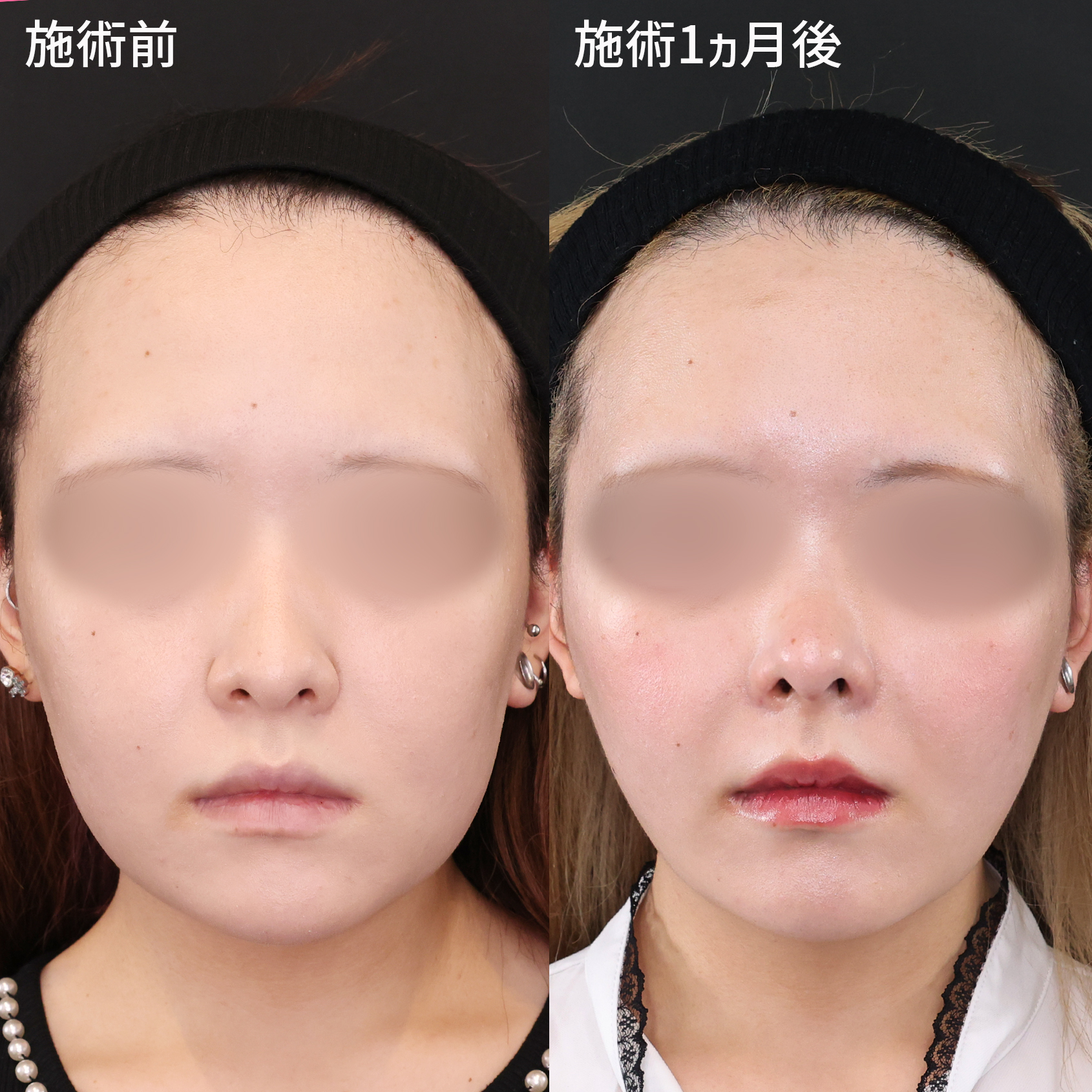 より洗練された印象へ。細くて高いアップノーズ！