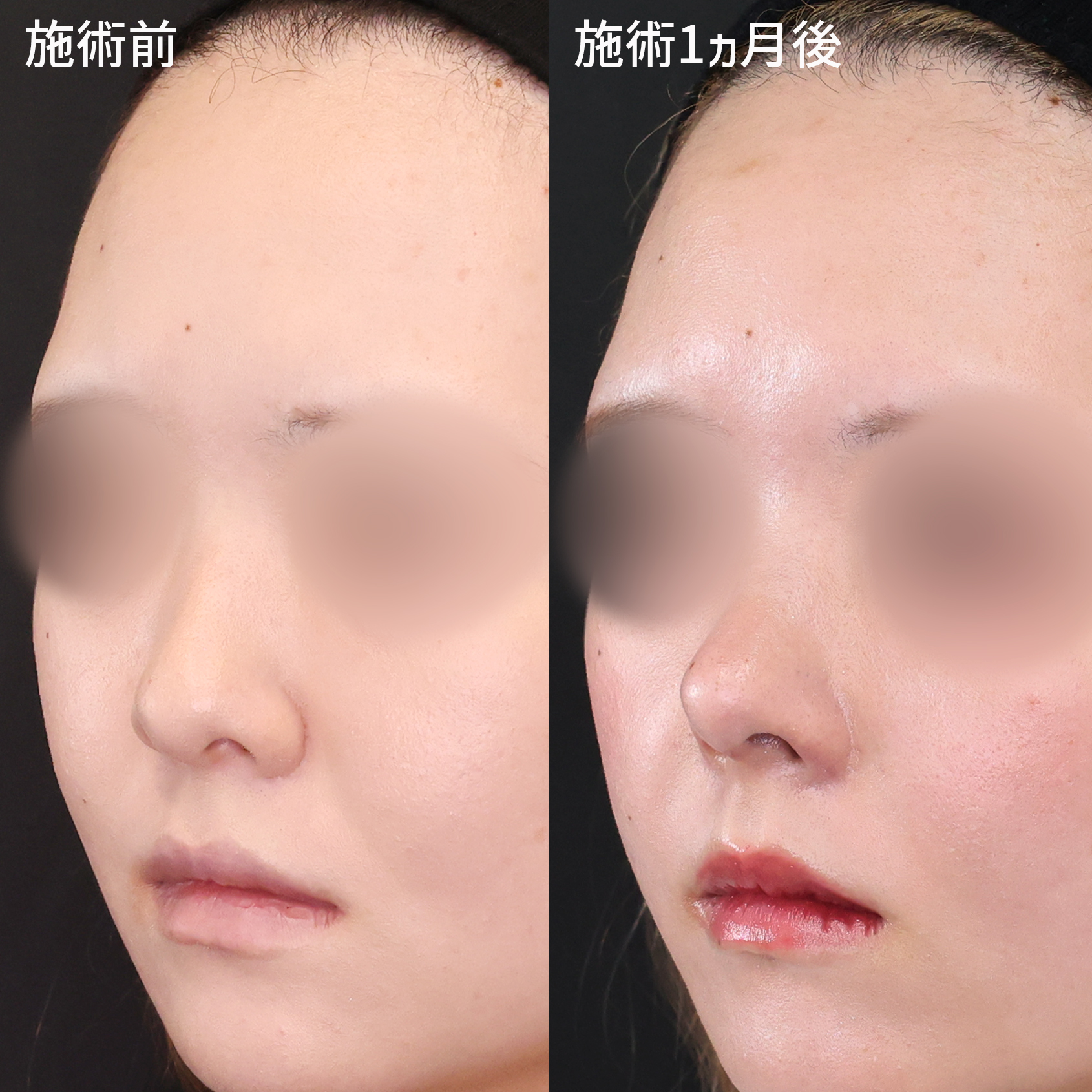 貴族手術（鼻翼基部プロテーゼ・脂肪注入・粉砕肋軟骨移植）/鼻中隔延長術/鼻尖形成・鼻尖縮小の症例写真 施術前後 