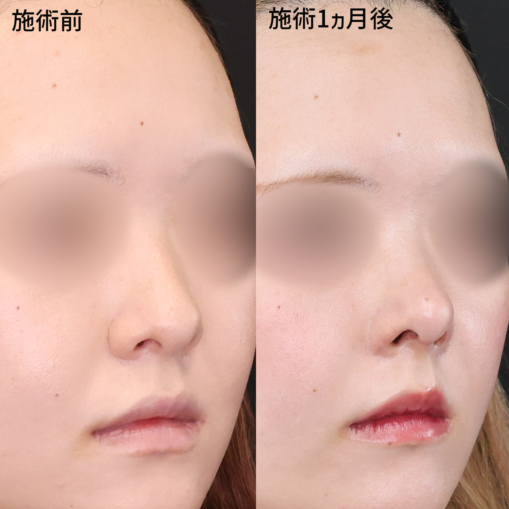 貴族手術（鼻翼基部プロテーゼ・脂肪注入・粉砕肋軟骨移植）/鼻中隔延長術/鼻尖形成・鼻尖縮小の症例写真 施術前後 