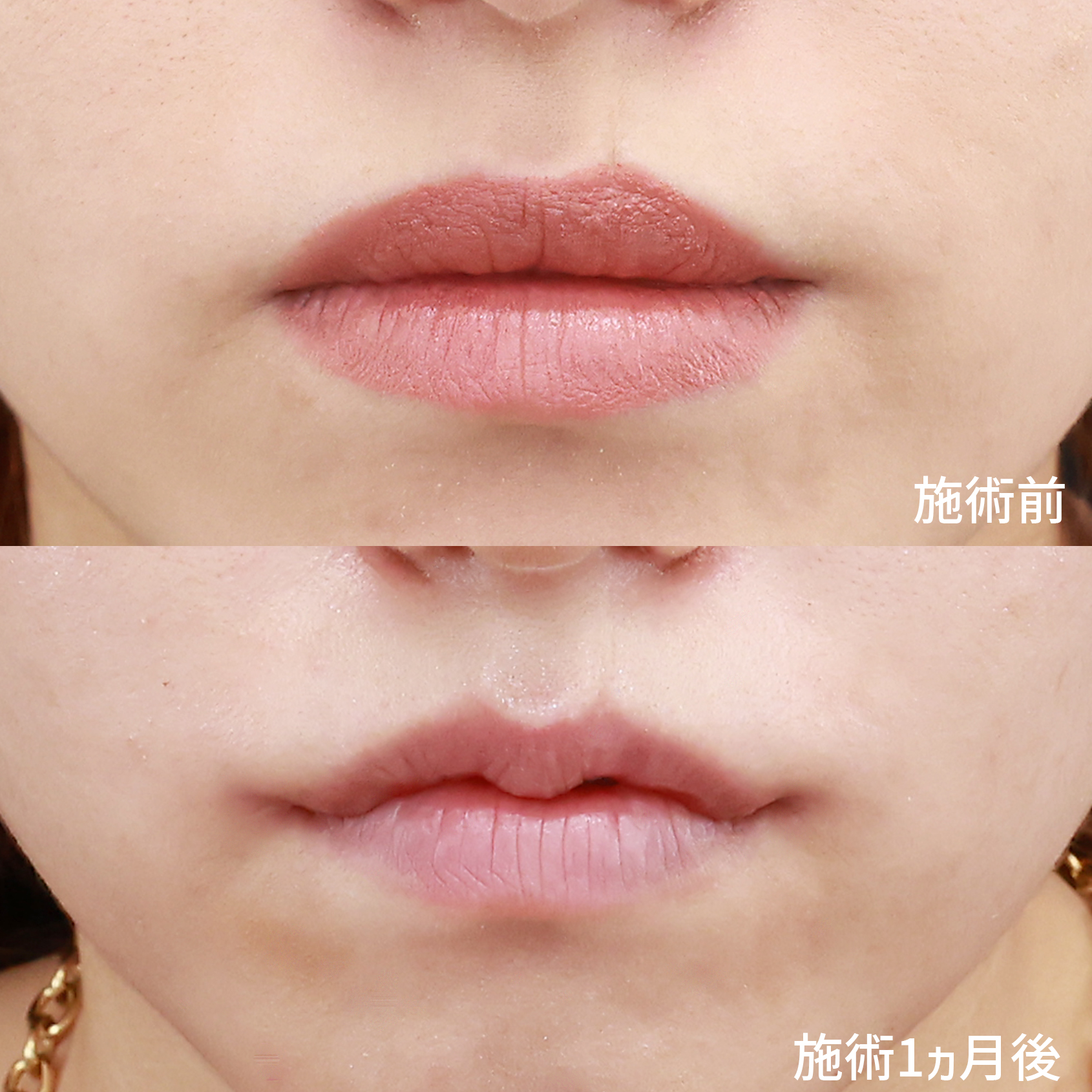 【M字リップ形成術】印象的で可愛らしい唇へ。