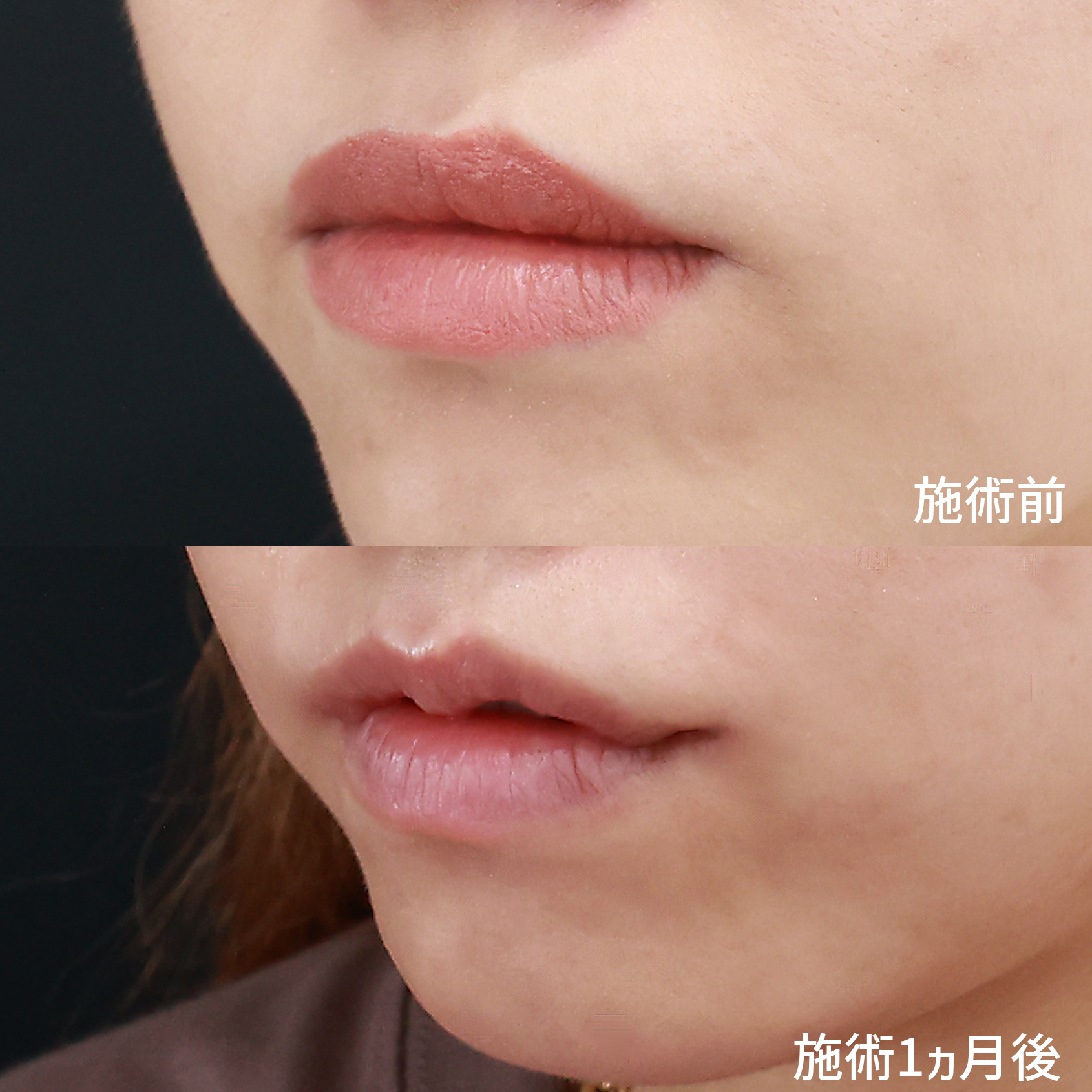 M字リップ形成術/口角挙上・リフト（マイクロ切開法・内側法/口内法）の症例写真 施術前後 