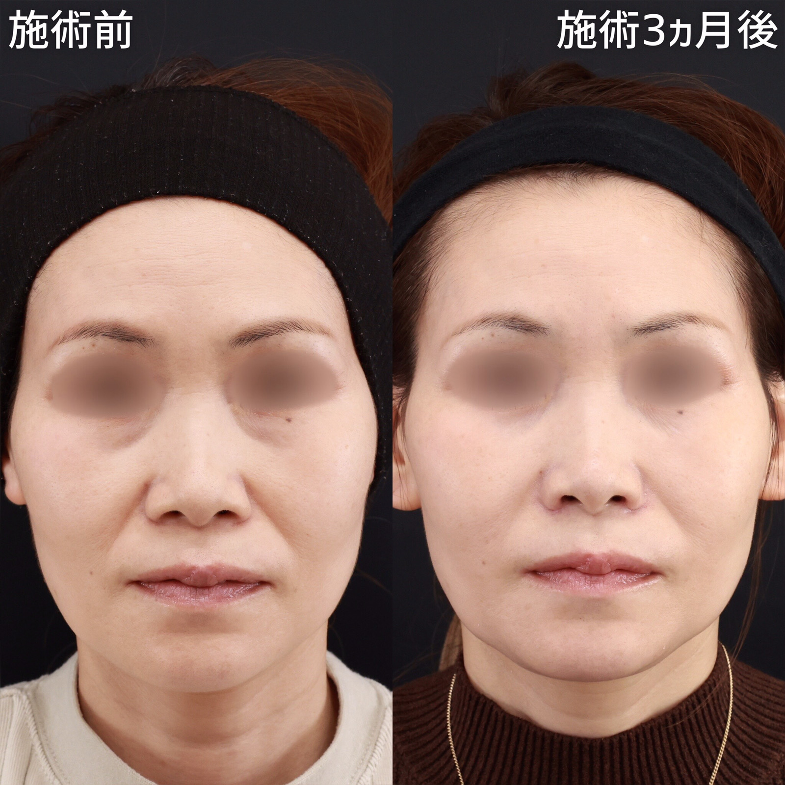 【鼻翼縮小&amp;鼻孔縁挙上】小鼻の存在感を薄くする