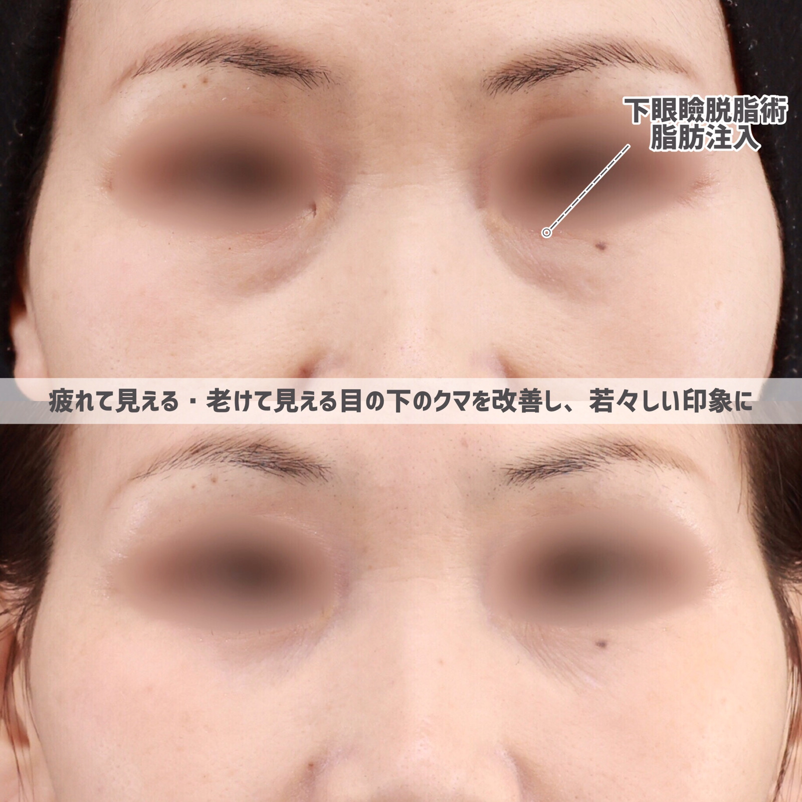 TAC式 鼻翼縮小術（小鼻縮小）/鼻孔縁挙上術/顔の脂肪注入(コンデンスリッチフェイス)の症例写真 施術前後 