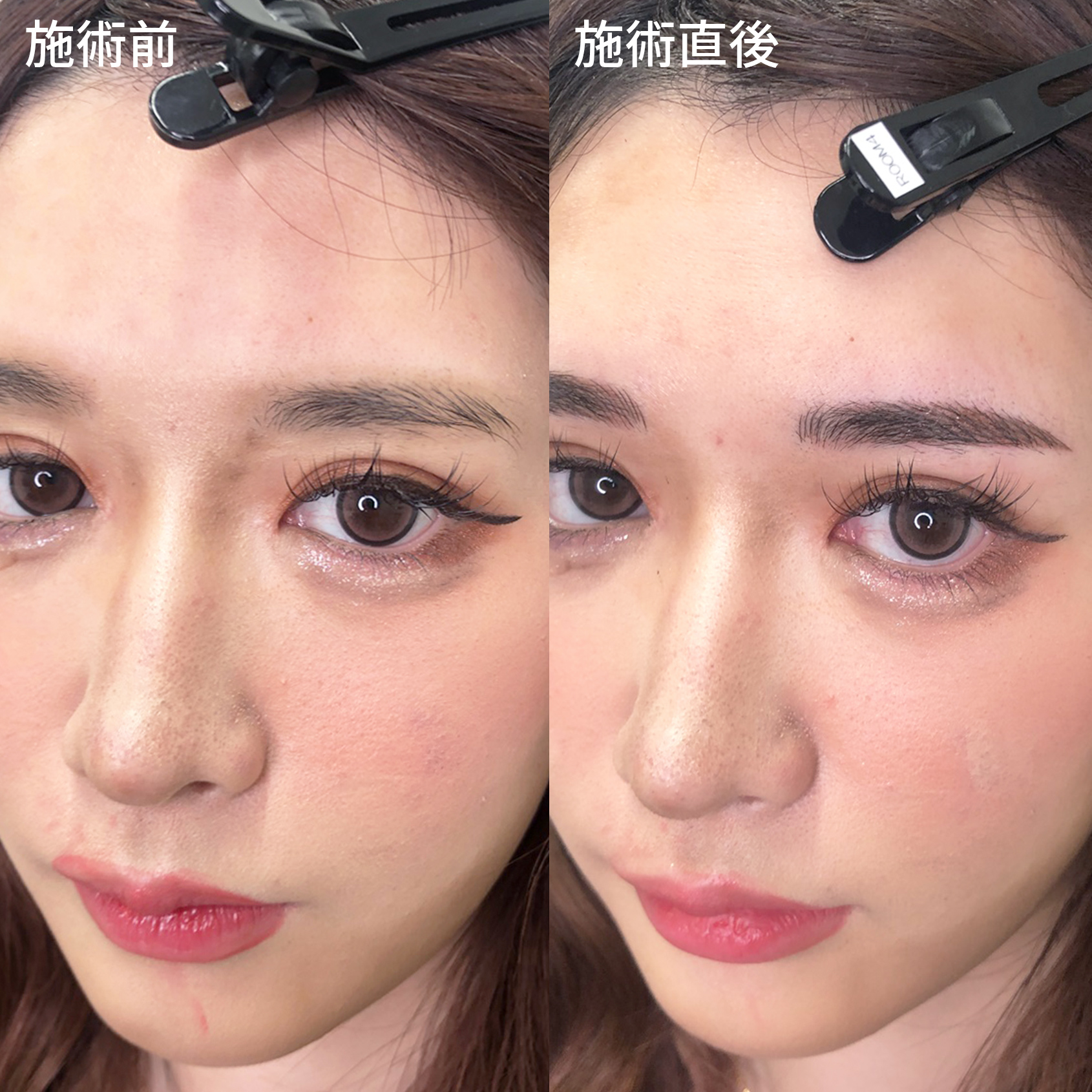 TACメディカルアートメイク（眉・アイライン・リップ）の症例写真 施術前後 