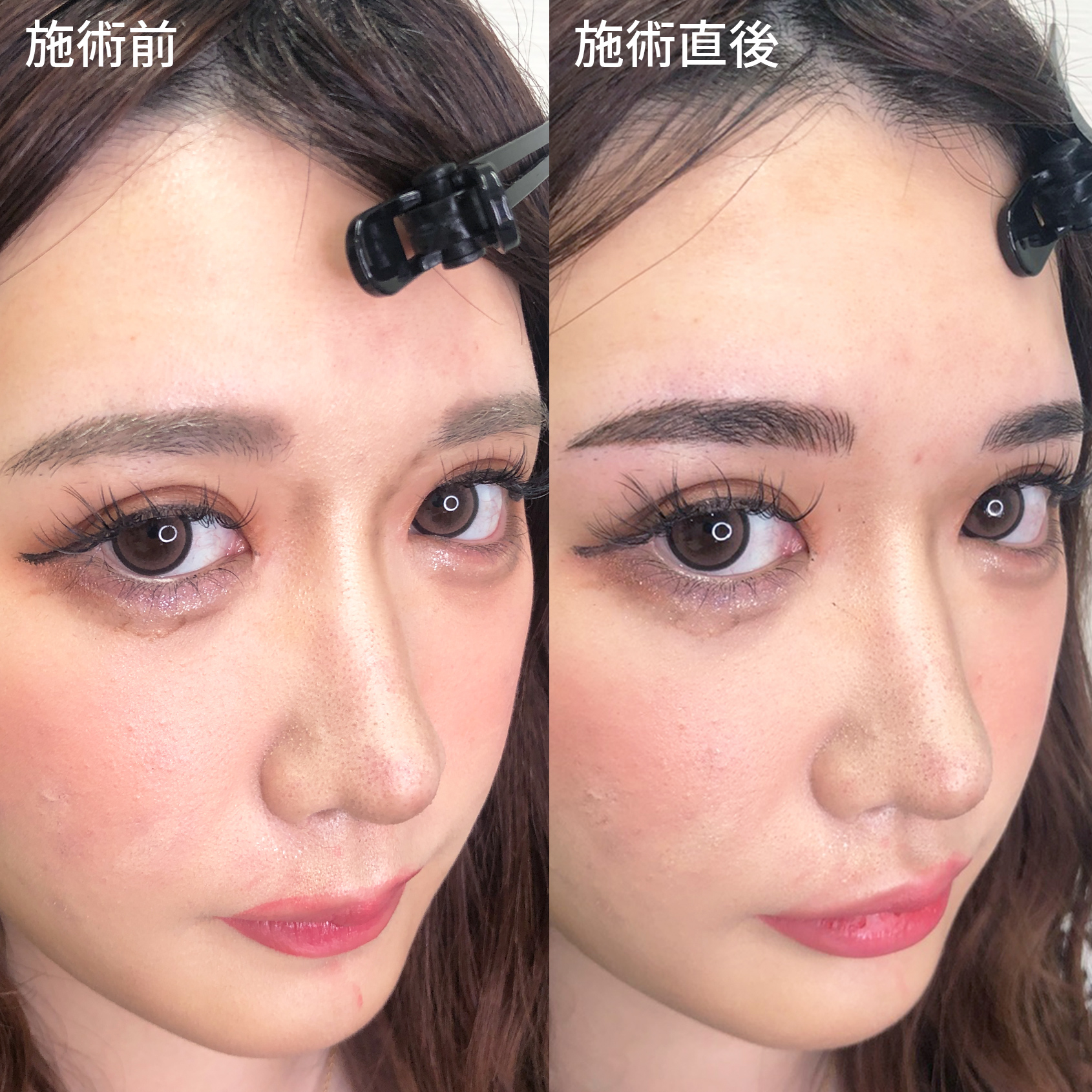 TACメディカルアートメイク（眉・アイライン・リップ）の症例写真 施術前後 