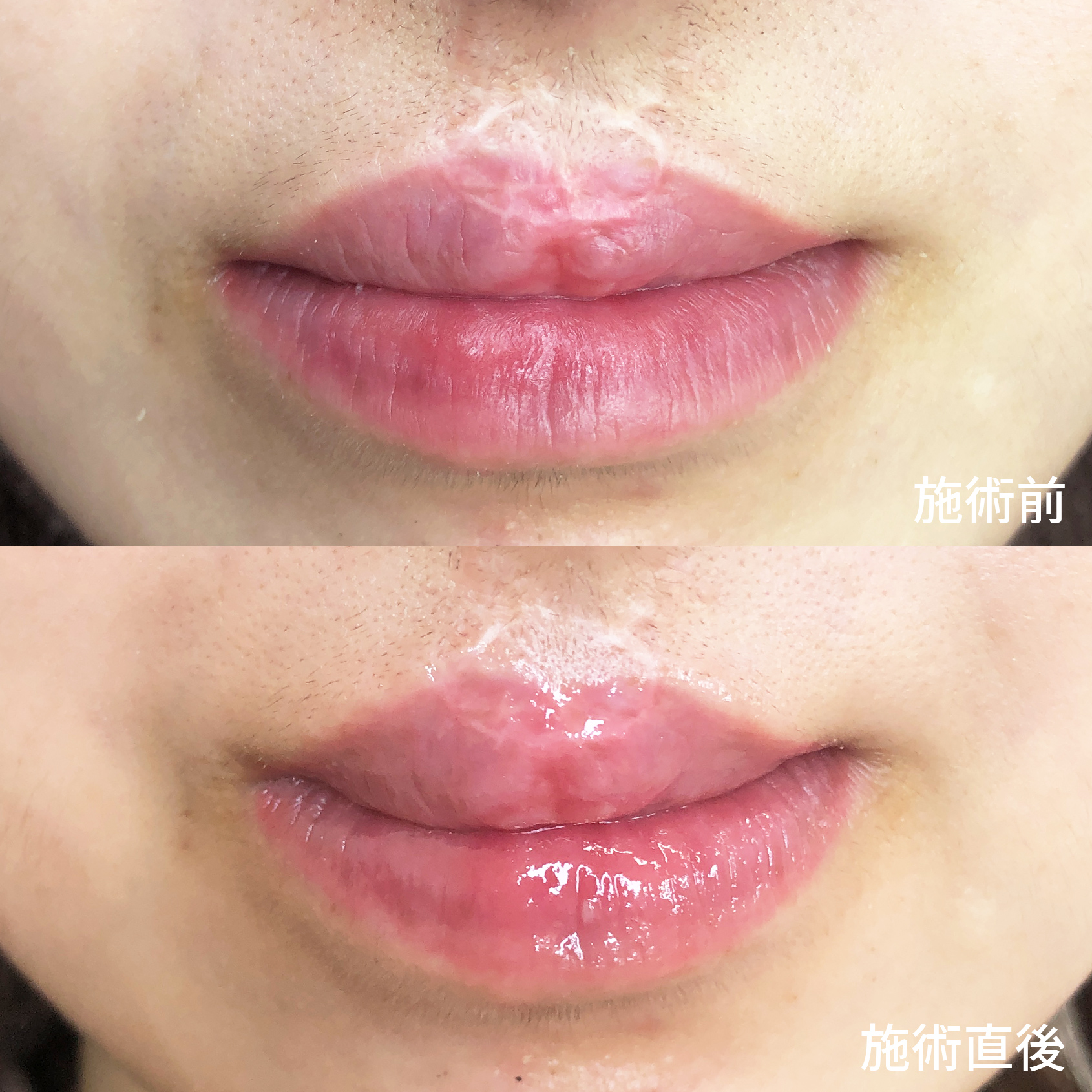 アートメイクSkin52（妊娠線・肉割れ・ストレッチマーク・リスカ跡・傷跡修正）/TACメディカルアートメイク（眉・アイライン・リップ）の症例写真 施術前後 