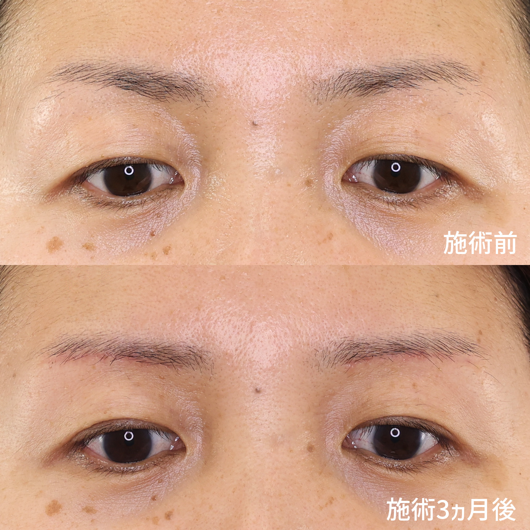 眉毛下切開術の症例写真 施術前後 
