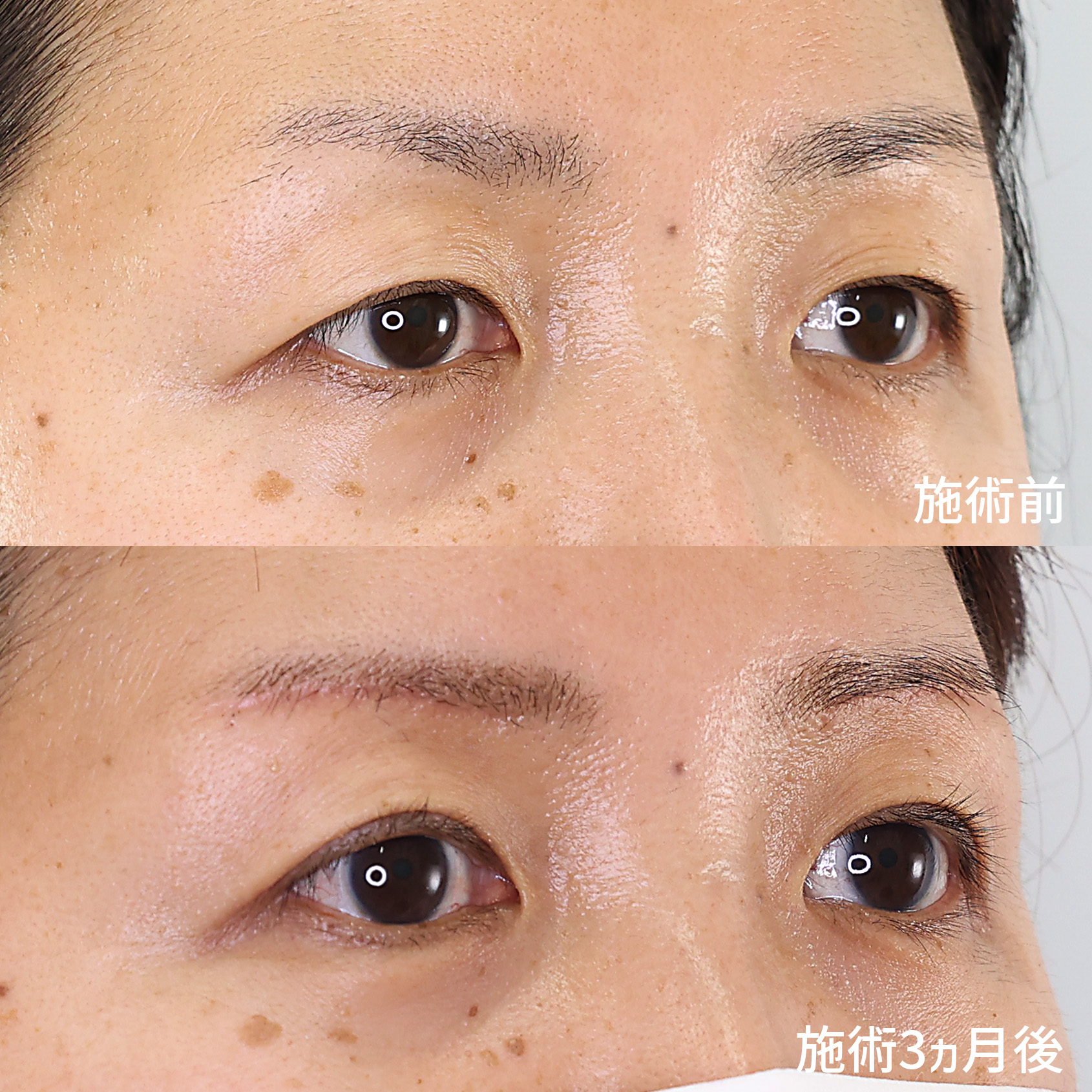 年齢と共にたるむまぶたを【眉毛下切開術】でスッキリと若々しい印象に