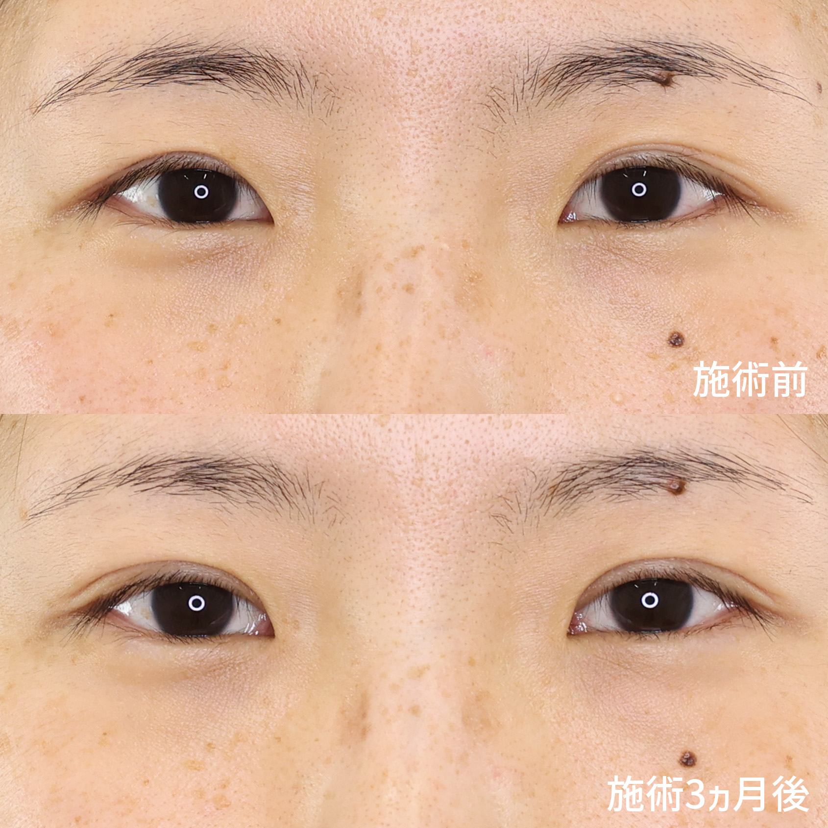 左右差のあった目元がしっかりと改善。【全切開法】で美しい二重ラインを半永久的に！！