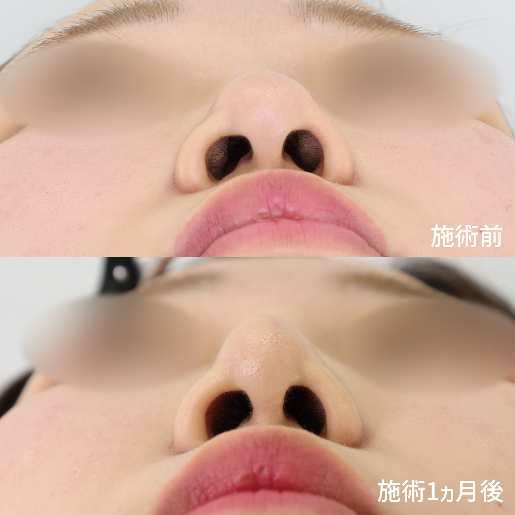 隆鼻術（プロテーゼ・自家組織）/鼻尖形成・鼻尖縮小の症例写真 施術前後 