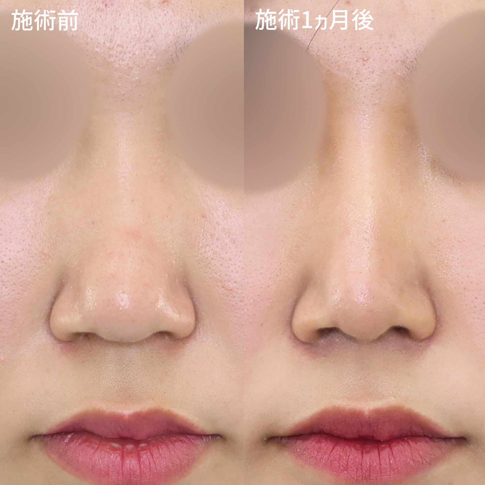 隆鼻術（プロテーゼ・自家組織）/鼻尖形成・鼻尖縮小の症例写真 施術前後 