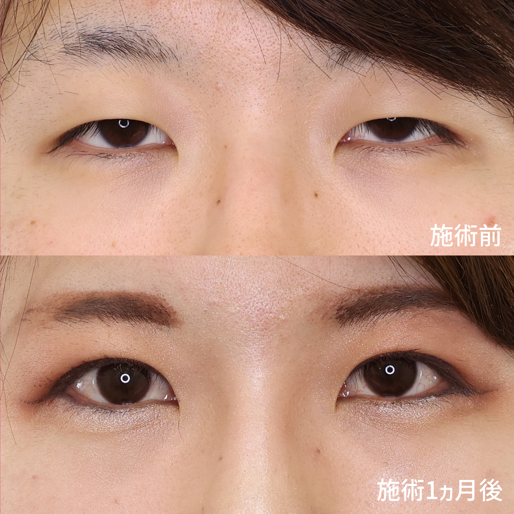 切開法でたるみに負けないパッチリ二重に！！【二重全切開法】