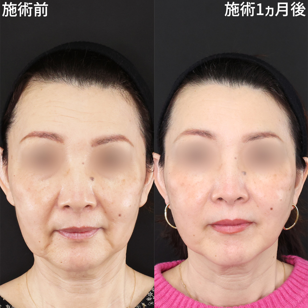 【50代】も糸リフトでたるみ改善！！