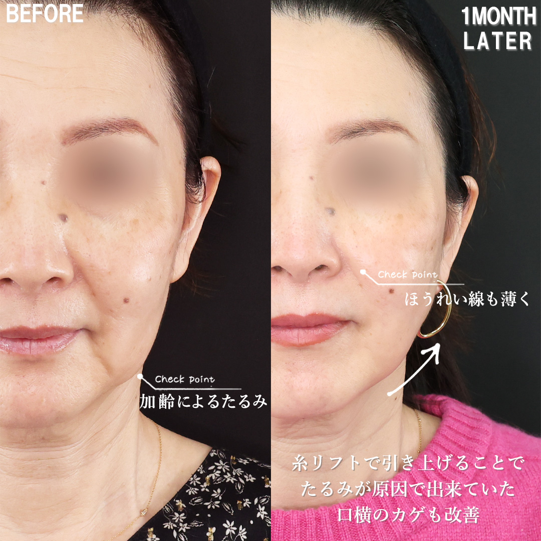 TAC式 ツヤ肌コラーゲンリフト®の症例写真 施術前後 