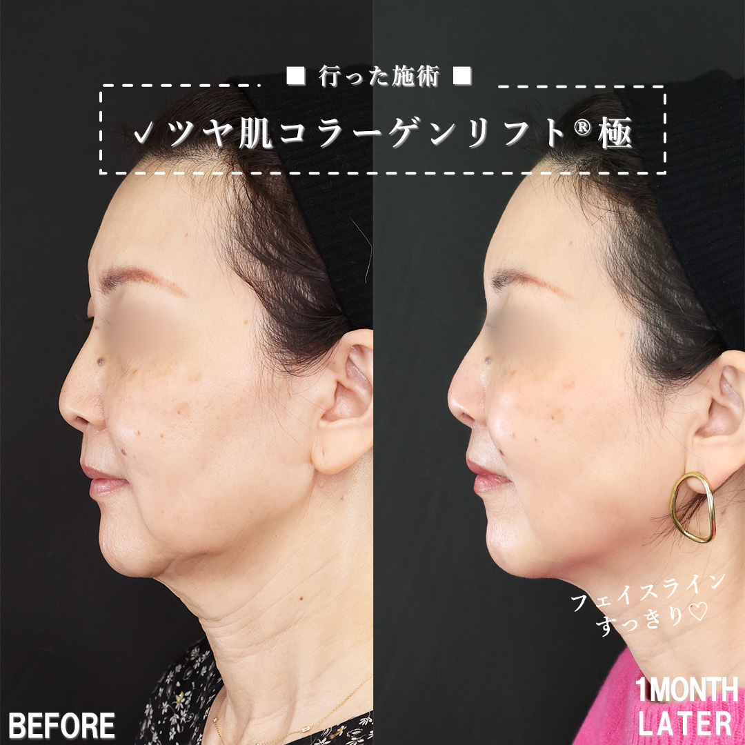 TAC式 ツヤ肌コラーゲンリフト®の症例写真 施術前後 