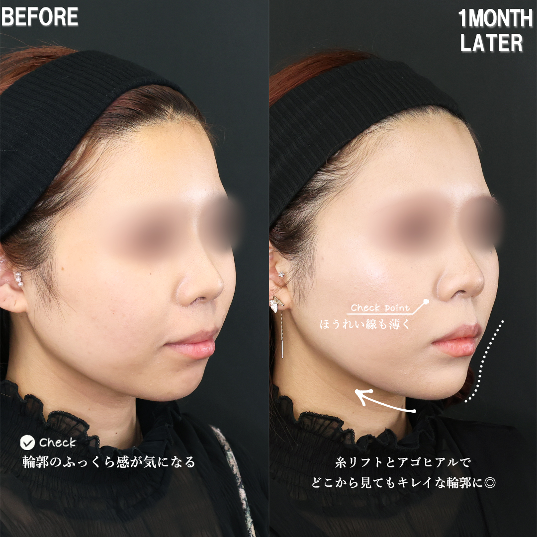 TAC式 ツヤ肌コラーゲンリフト®/エラボトックス注射/顎のヒアルロン酸注射の症例写真 施術前後 