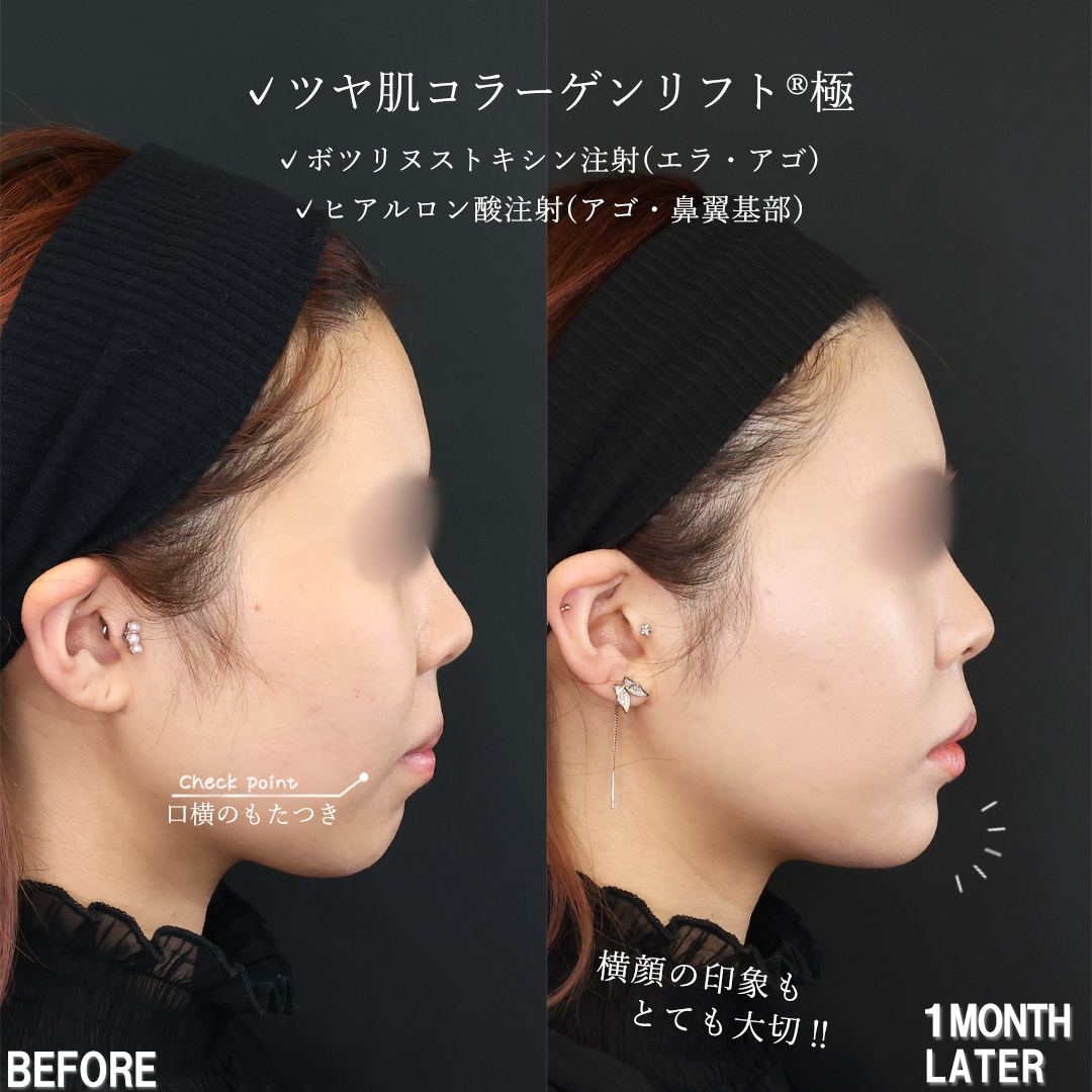 TAC式 ツヤ肌コラーゲンリフト®/エラボトックス注射/顎のヒアルロン酸注射の症例写真 施術前後 