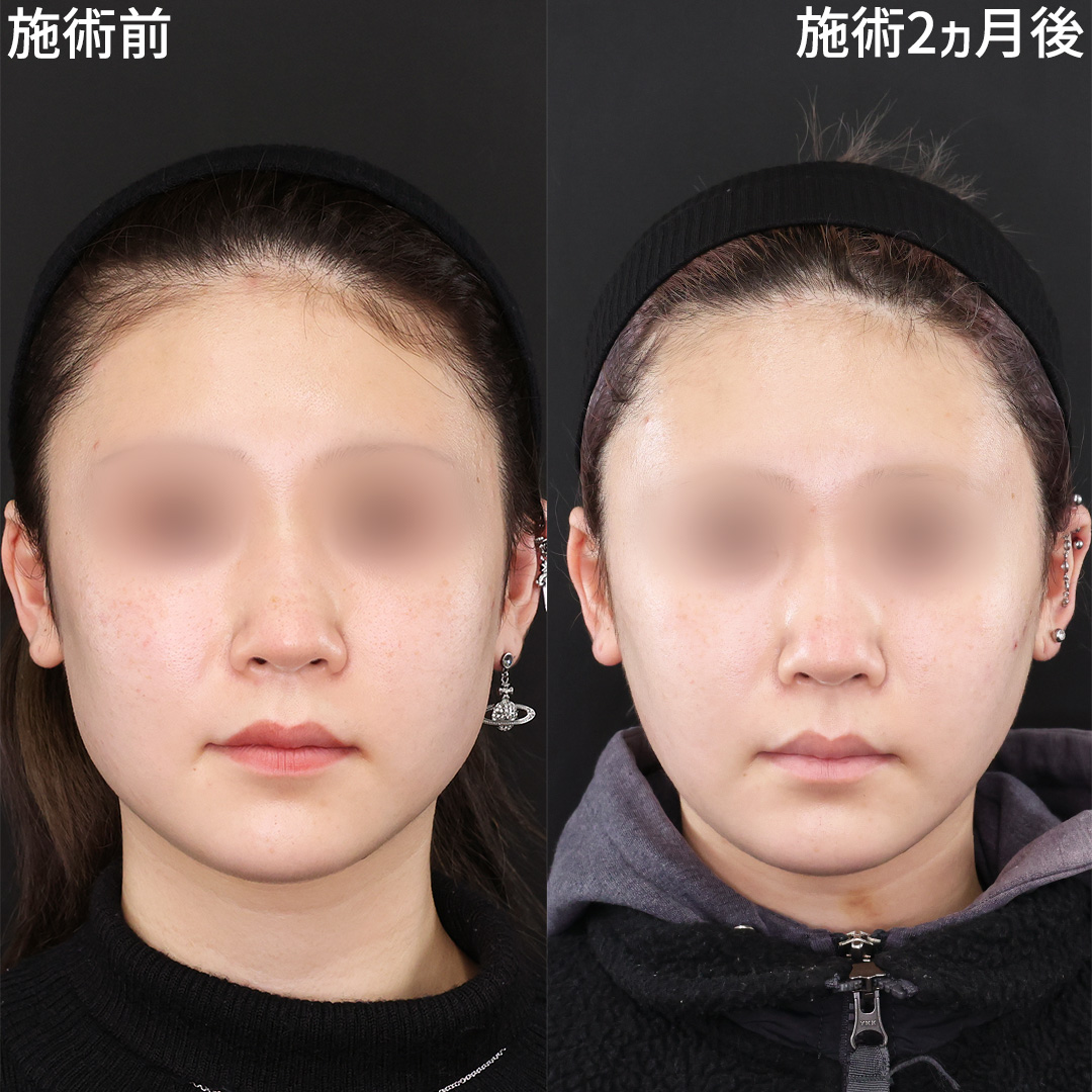 《脂肪除去×糸リフト》自然な卵型フェイスライン
