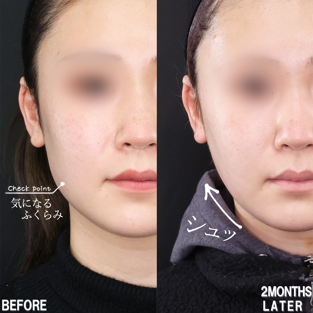 TAC式 ツヤ肌コラーゲンリフト®/バッカルファット除去/ジョールファット除去の症例写真 施術前後 