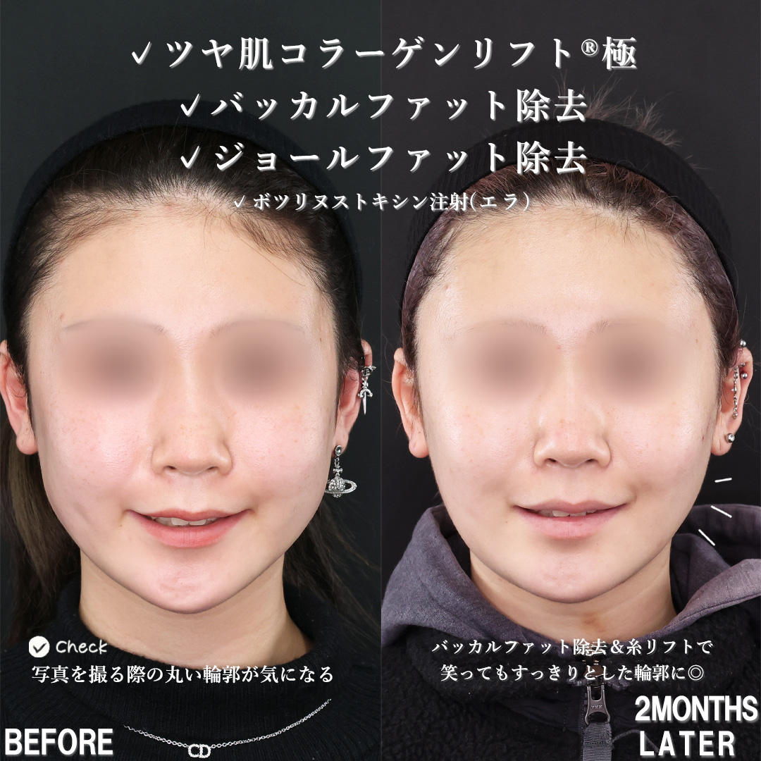TAC式 ツヤ肌コラーゲンリフト®/バッカルファット除去/ジョールファット除去の症例写真 施術前後 