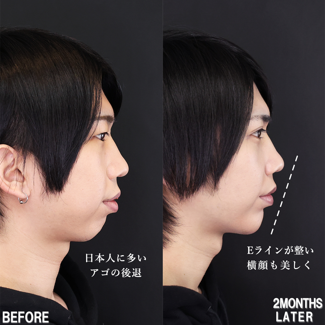 小顔整形｜パーフェクトフェイスライン/TAC式 ツヤ肌コラーゲンリフト®/バッカルファット除去の症例写真 施術前後 