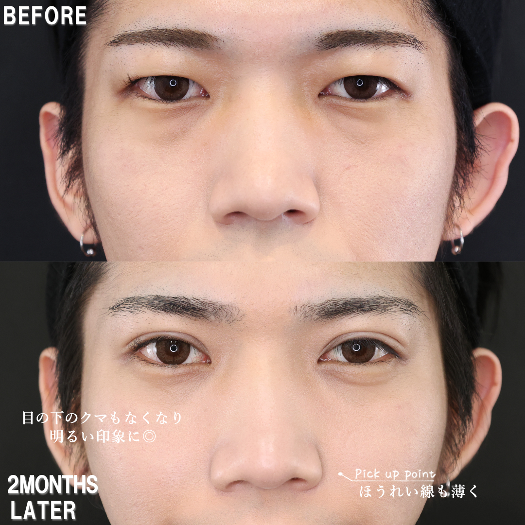 小顔整形｜パーフェクトフェイスライン/TAC式 ツヤ肌コラーゲンリフト®/バッカルファット除去の症例写真 施術前後 