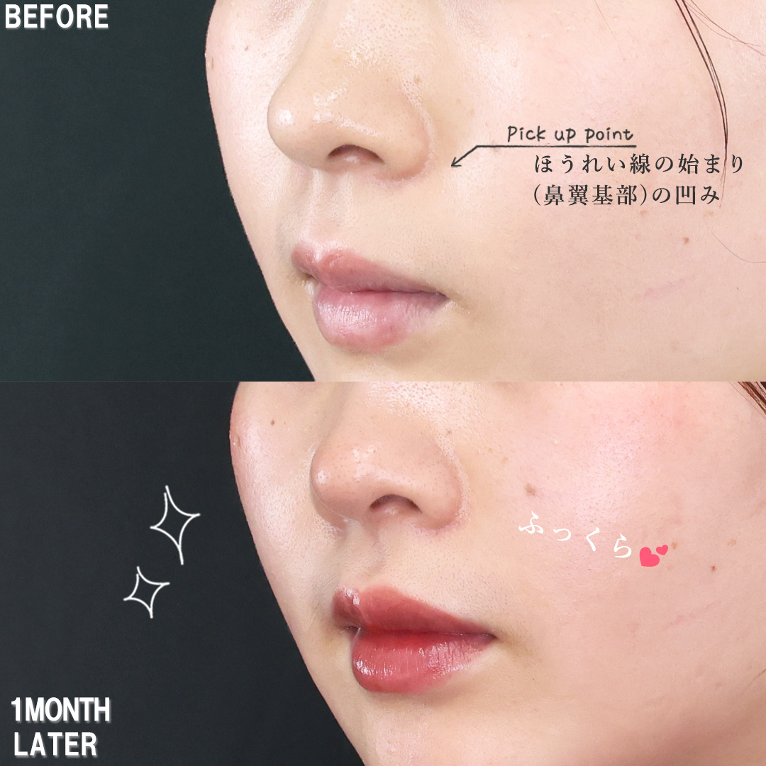 TAC式 ツヤ肌コラーゲンリフト®/ほうれい線のヒアルロン酸注射/エラボトックス注射の症例写真 施術前後 