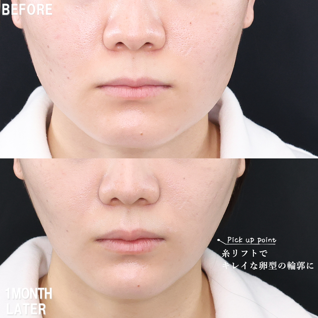 小顔整形｜パーフェクトフェイスライン/TAC式 ツヤ肌コラーゲンリフト®/メーラーファット除去の症例写真 施術前後 