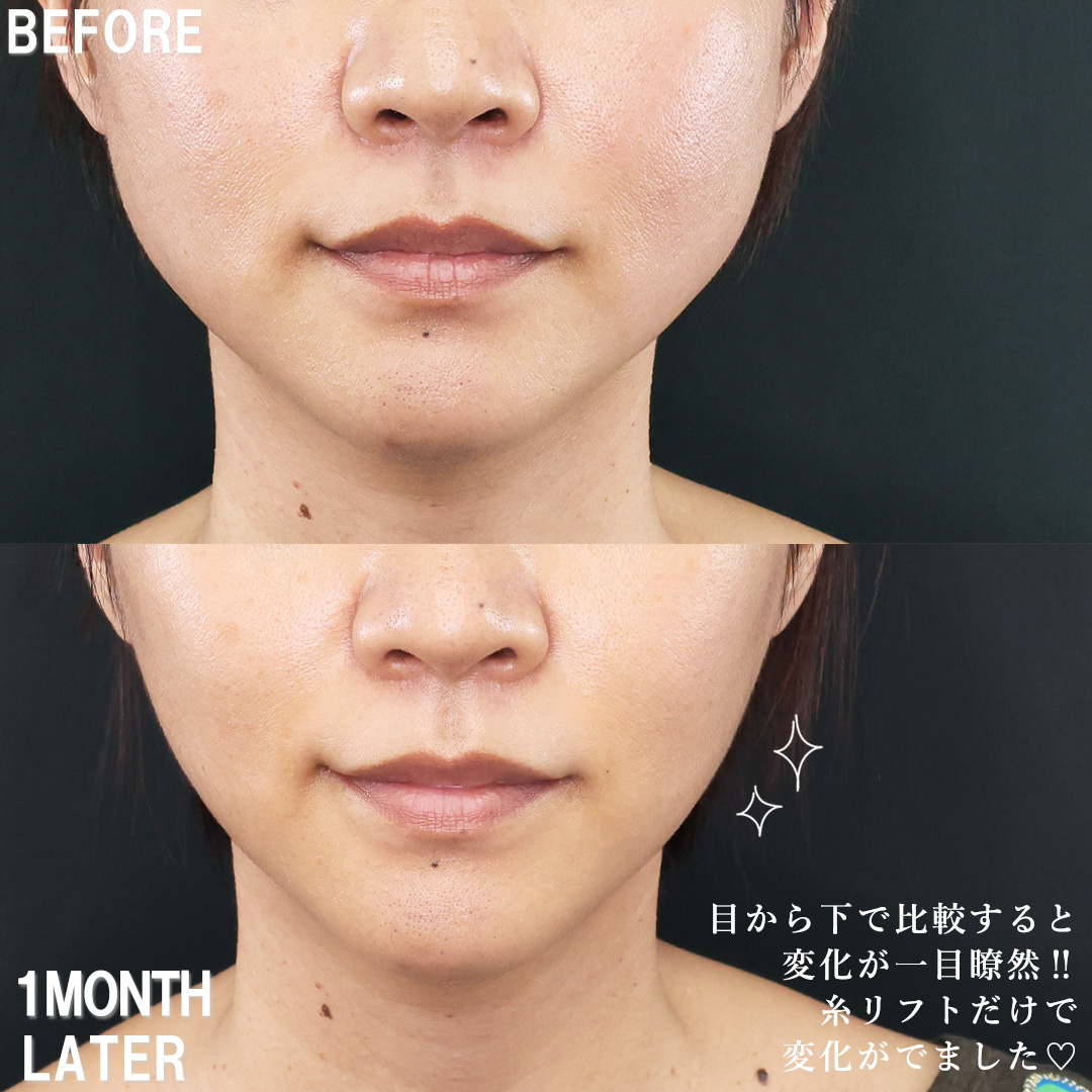 TAC式 ツヤ肌コラーゲンリフト®/エラボトックス注射の症例写真 施術前後 