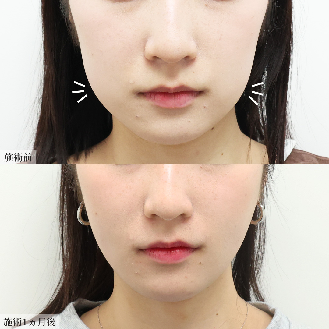 TAC式 ツヤ肌コラーゲンリフト®/顔の脂肪吸引/ジョールファット除去の症例写真 施術前後 