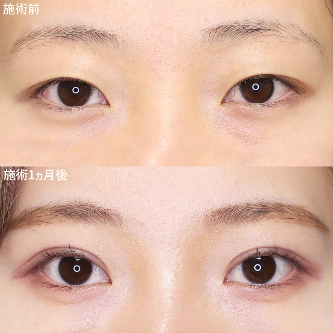 【二重のり卒業】古川先生の二重術