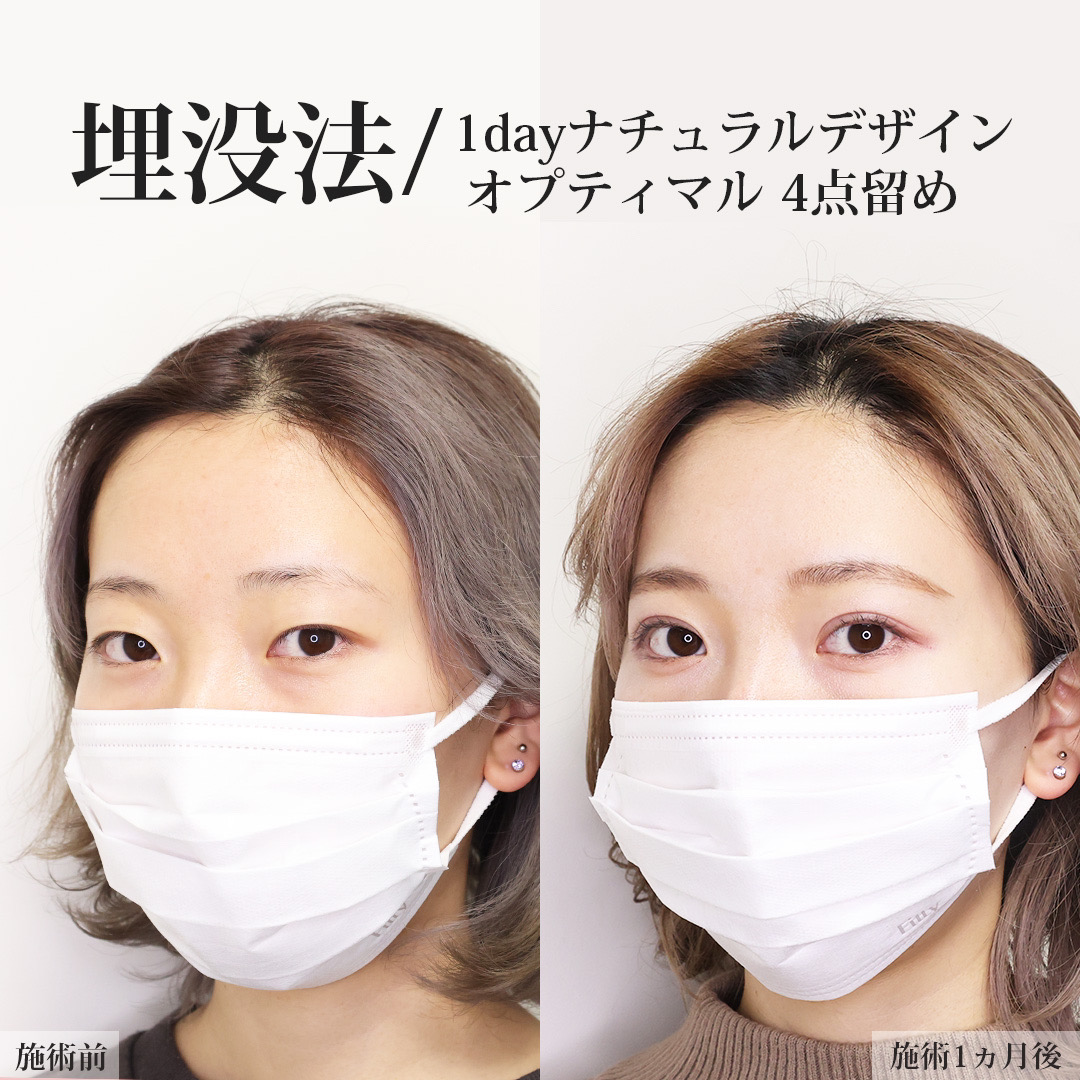 二重埋没法の症例写真 施術前後 