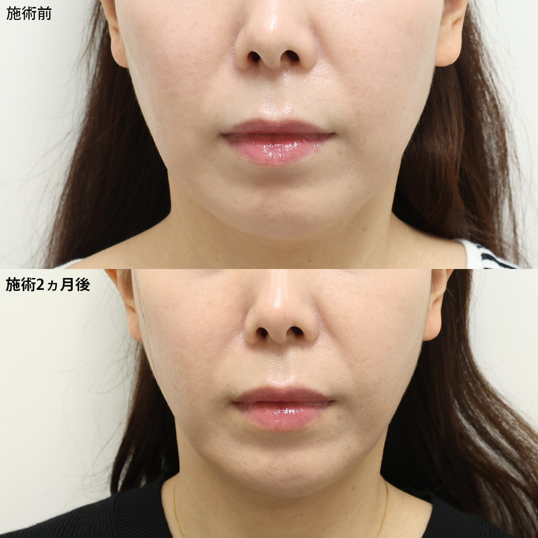 【気になっていたもたつき】を解消し若々しい印象へ