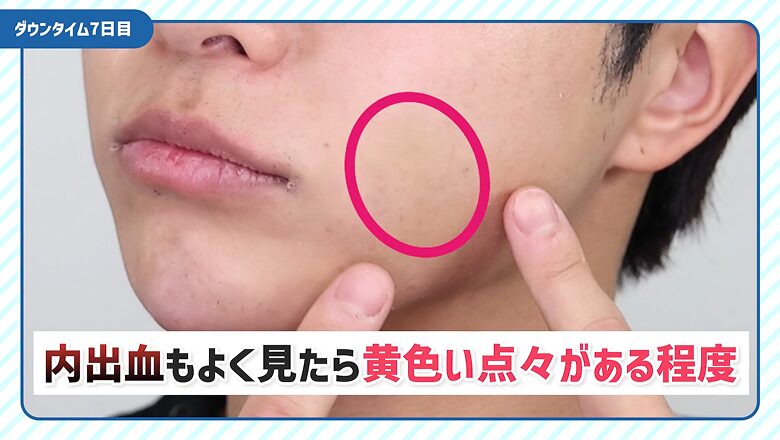 内出血の状態