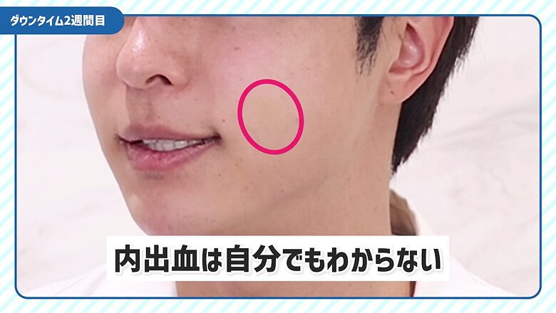 ジョールファット除去と糸リフトの術後12日目の経過