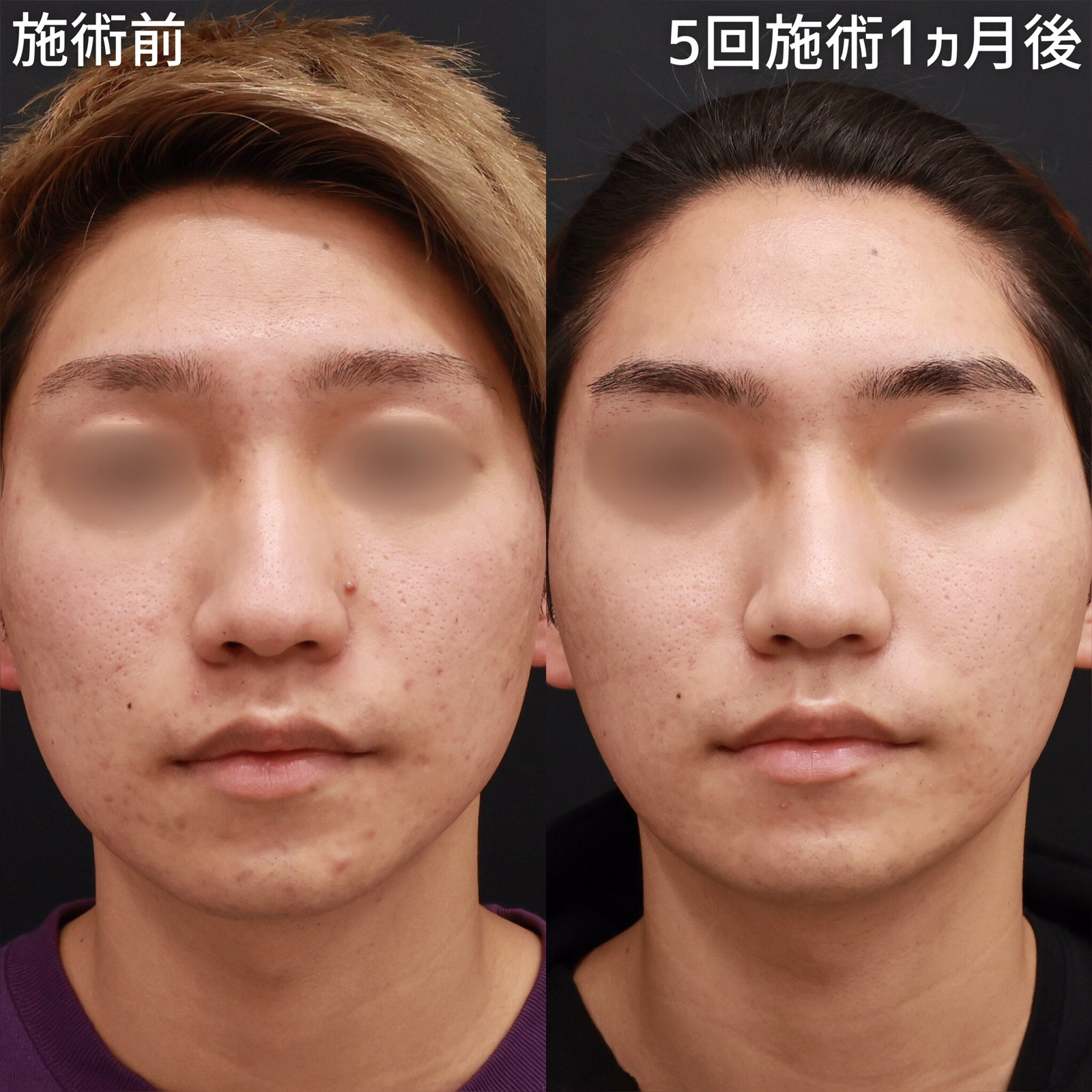 ヴァンパイアフェイシャルの症例写真 施術前後